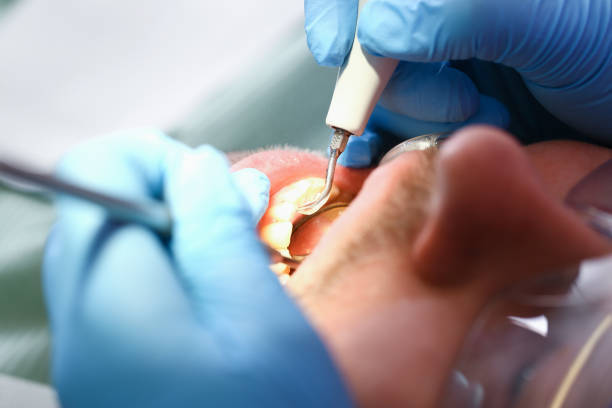 Best Emergency Dental Extractions in Web, AL