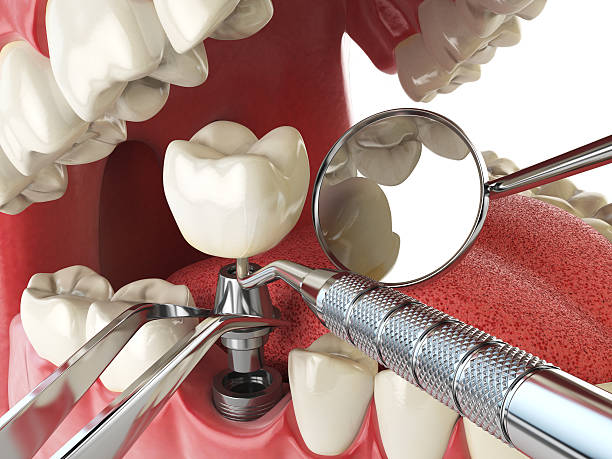 Best Emergency Dental Care for Abscessed Tooth in Web, AL